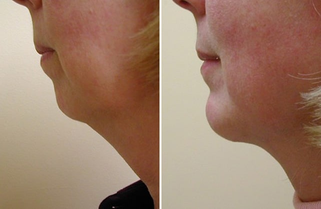 chin implant