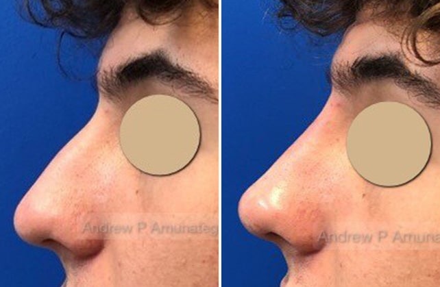 nose augumentation