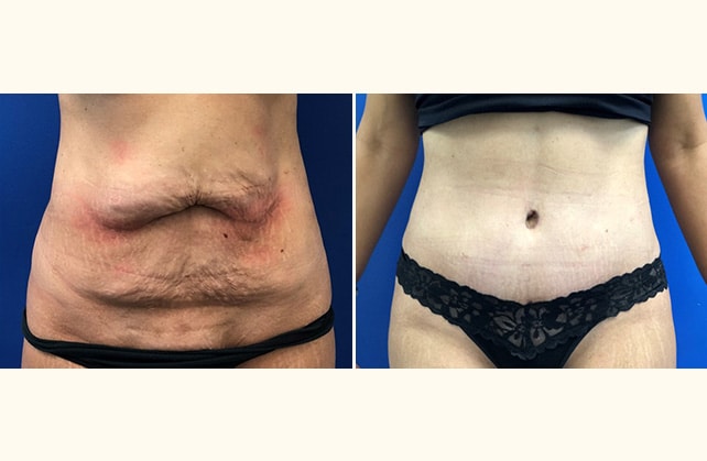 tummy tuck c9 front